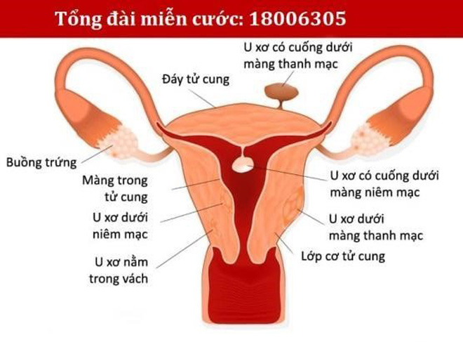 Hình ảnh bệnh u xơ tử cung