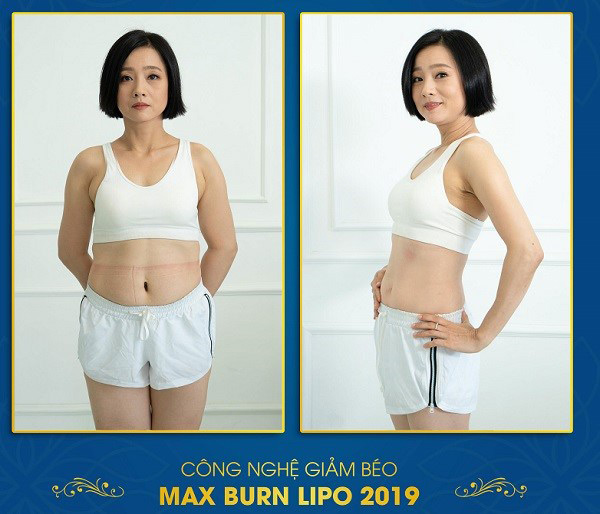 NSƯT Mỹ Duyên giảm mỡ bụng bằng công nghệ Max Burn Lipo