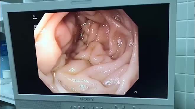 Vất vả lôi con sán dài cả thước trong người đàn ông quen ăn bò tái