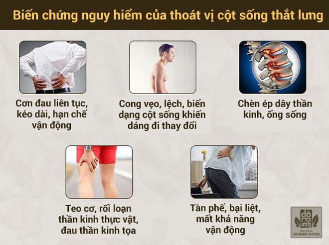 6 bài tập chữa thoát vị đĩa đệm đốt sống cổ, lưng hiệu quả không nên bỏ qua - 2