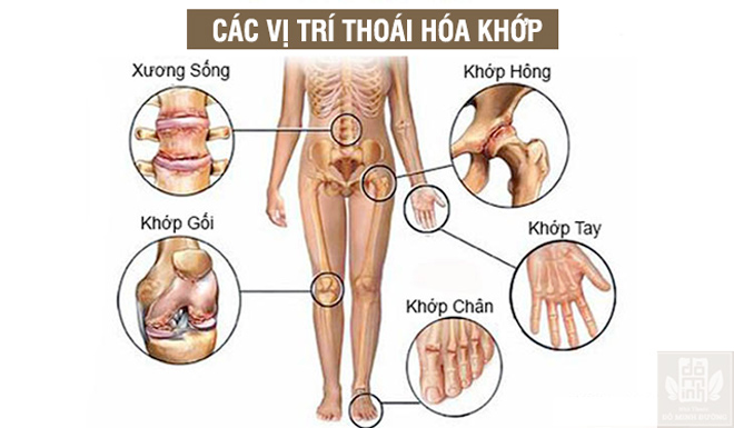 Các phương pháp điều trị thoái hóa khớp hiện nay, biện pháp nào tốt nhất? - 1