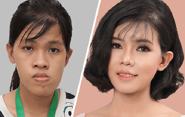 Hình ảnh khách hàng sử dụng dịch vụ chỉnh hình gương mặt Hàn Quốc