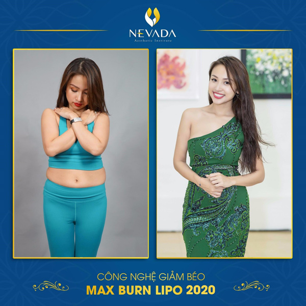 MC Vân Hugo sau một liệu trình Max Burn Lipo