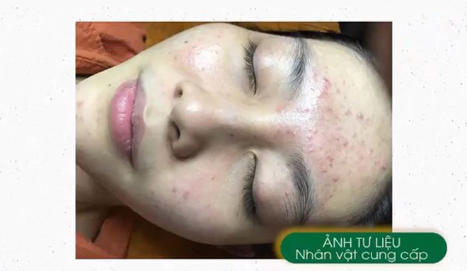 Hành trình tạm biệt mụn trứng lấy lại tự tin của nữ trình dược viên - 2