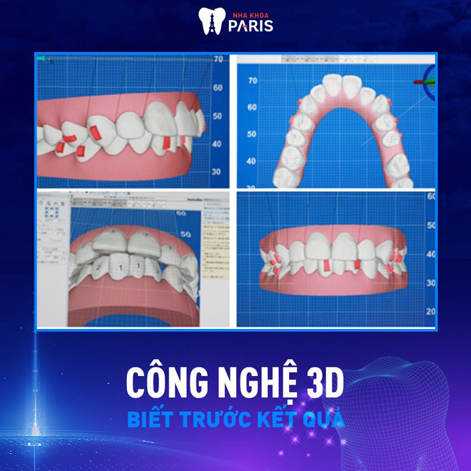 Lựa chọn công nghệ niềng răng mới niềng trước tết
