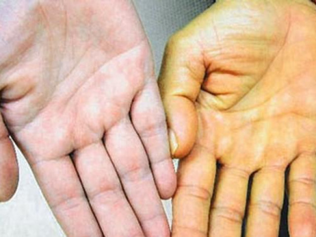 Sức khỏe đời sống - Người con vàng như nghệ, thủ phạm bất ngờ từ mẹ bỉm sữa