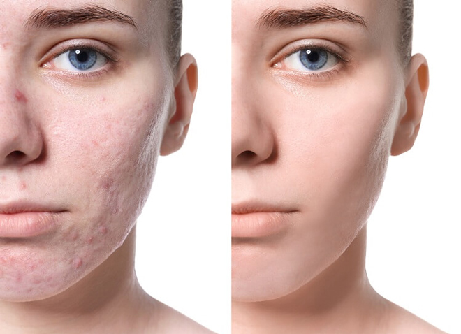 How to effectively fade perennial scars with super savings - 1
