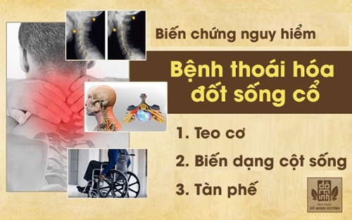 Danh y tiết lộ cách chữa thoái hóa đốt sống cổ hiệu quả, tránh nguy cơ tàn phế - 1