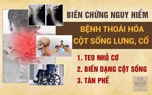 Triệu chứng thoái hóa đốt sống cổ, lưng và cách điều trị khỏi từ thảo dược - 2