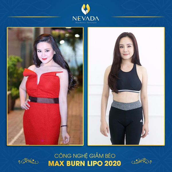 Diễn viên Vy Oanh và kết quả giảm béo bằng công nghệ Max Burn Lipo