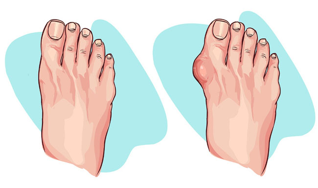 3 bộ phận cơ thể bị nguy hiểm khi bạn đi giày cao gót quá nhiều - 4