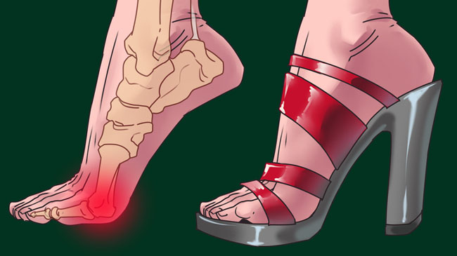 3 bộ phận cơ thể bị nguy hiểm khi bạn đi giày cao gót quá nhiều - 5