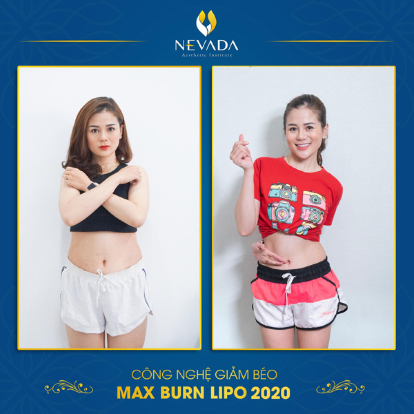 Diễn viên Trang Moon sau một liệu trình Max Burn Lipo