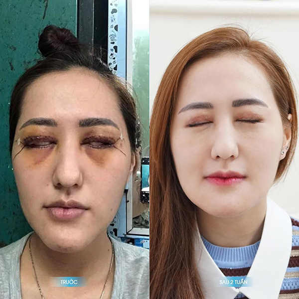 50 triệu đồng và 10 tiếng đau đớn nhận lại đôi mắt hỏng không thể khép mí - 2