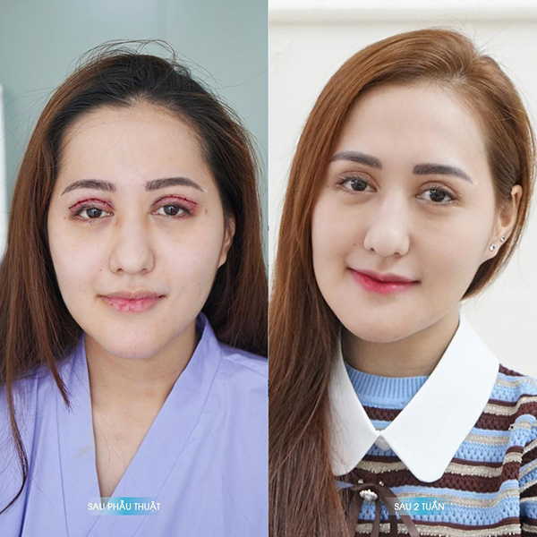 50 triệu đồng và 10 tiếng đau đớn nhận lại đôi mắt hỏng không thể khép mí - 3