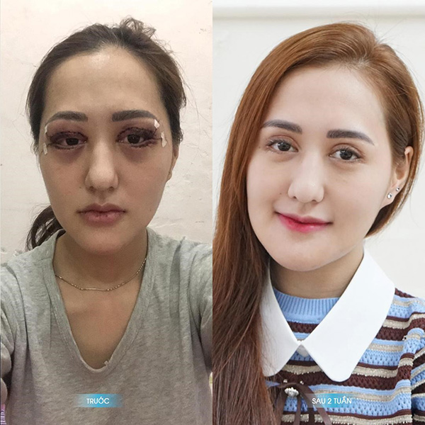 Ng trước và sau khi tái phẫu thuật tại Viện phẫu thuật thẩm mỹ Plasma.