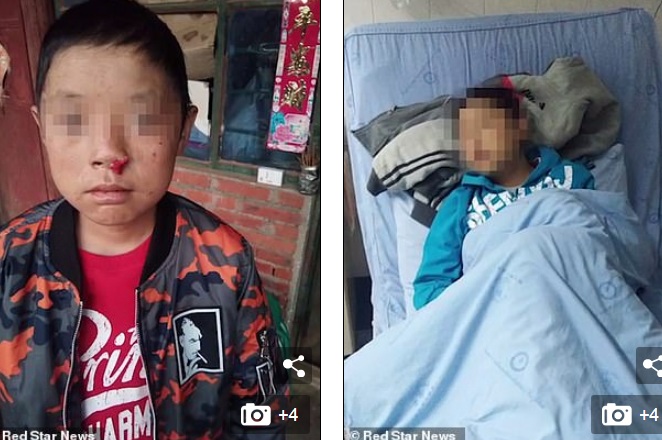 Xiao Luo mắc chứng bệnh hiếm gặp khiến cơ thể phản ứng dưới ánh Mặt trời như ma cà rồng.