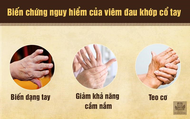 Viêm đau khớp cổ tay và cách chữa hiệu quả giúp cử động dễ dàng - 1