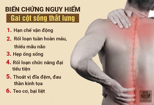 Bệnh gai cột sống thắt lưng: Cần sớm điều trị để tránh nguy cơ tàn phế - 2