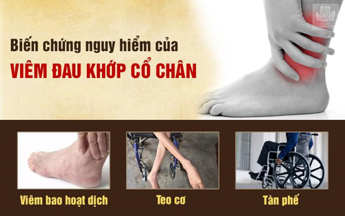 Viêm đau khớp cổ chân: Nguyên nhân, triệu chứng, cách chữa giúp hết đau nhức - 1