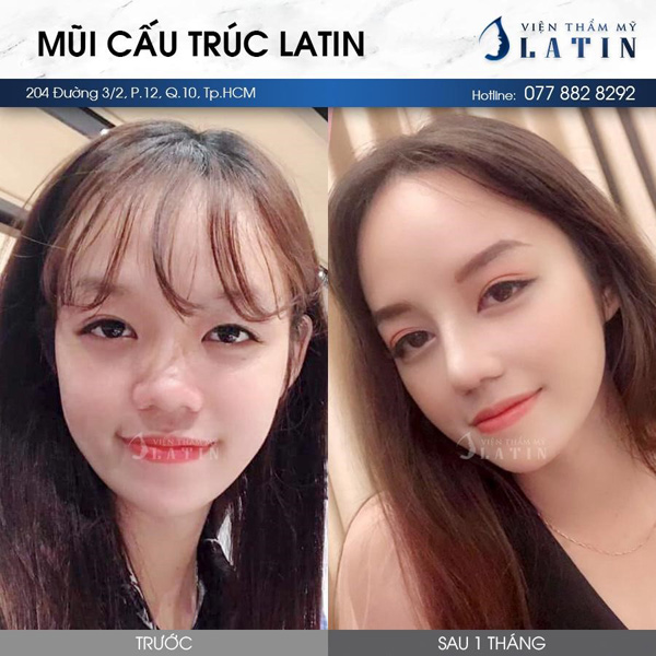 “Cơn sốt” nâng mũi cấu trúc dáng Latin đẹp toàn diện - 1