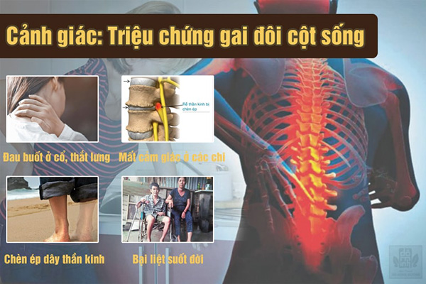 Gai đôi cột sống: Triệu chứng, nguyên nhân và cách điều trị hiệu quả - 2