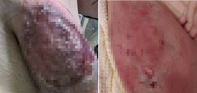 Tình trạng hiếm gặp khiến cô gái bị thối rữa khắp cơ thể - 1