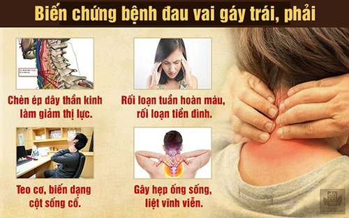Đau vai gáy bên trái, phải là bệnh gì và cách điều trị hiệu quả tận gốc - 2