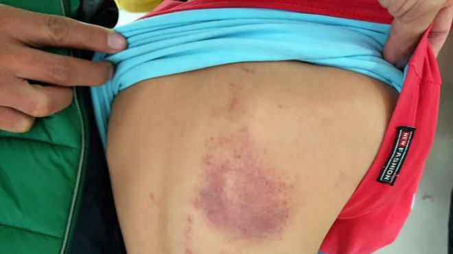 Lưng cháu P bị tím bầm sau khi bị cô chủ nhiệm dùng thước kẻ đánh (Ảnh: Lã Tiến)