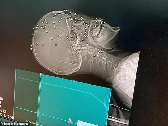 Phi thường - kỳ quặc - Thợ săn bị bạn bắn thẳng vào mặt vì tưởng là con mồi