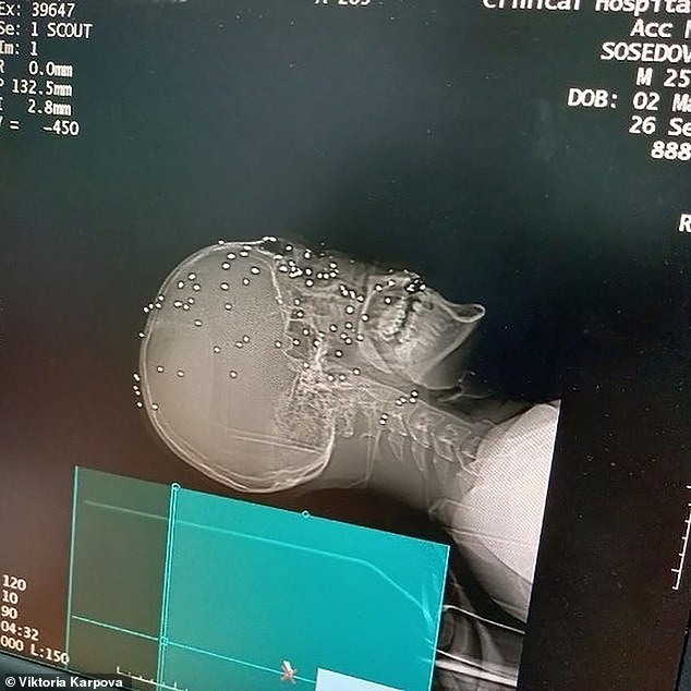 Những mảnh đạn găm vào mặt nạn nhân.