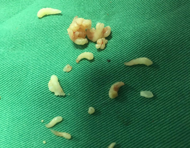 Khối u răng với gần 20 chiếc răng nhỏ đã được phẫu thuật thành công - Ảnh: Bệnh viện cung cấp