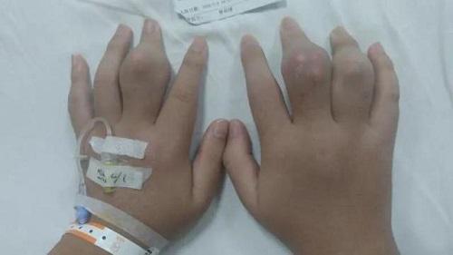 Các khớp tay sưng cục đáng sợ của Tiểu Hải.