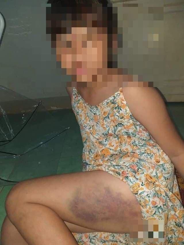 Em T.B.T.Đ. bị cô giáo đánh bầm dập. Ảnh Facebook