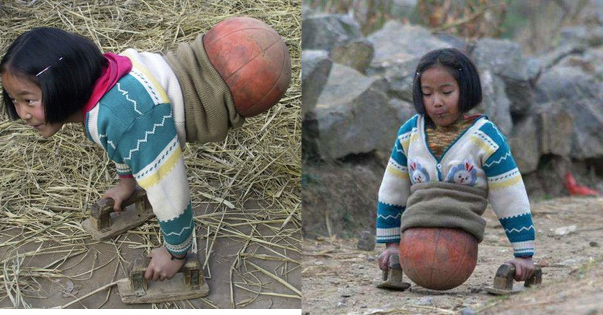 Bạn trẻ - Cuộc sống - Nhan sắc xinh đẹp "vịt hoá thiên nga" của cô bé nửa thân dưới là quả bóng rổ