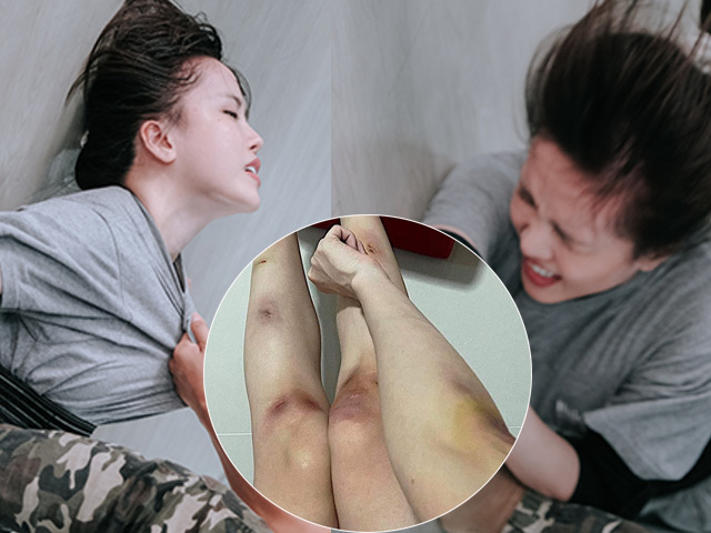 Ca nhạc - MTV - Thiều Bảo Trâm bị đánh tơi bời, tay chân bầm dập khiến fan xót xa