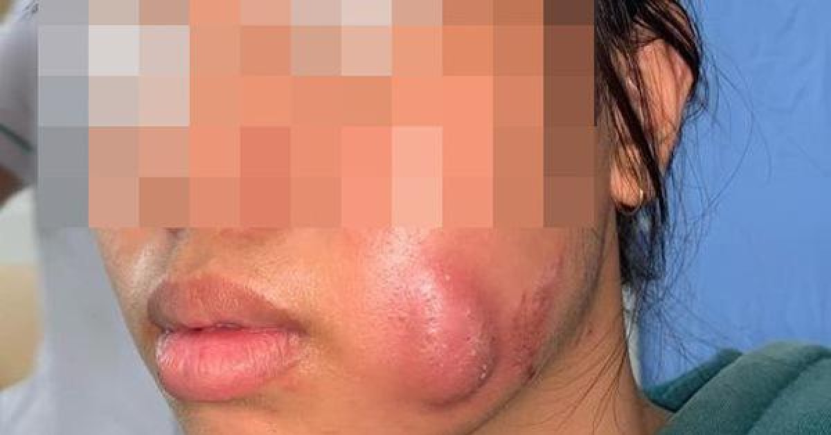 Sức khỏe đời sống - Tạo má lúm đồng tiền làm duyên, thiếu nữ 16 tuổi bị sưng vù mặt