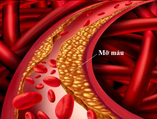 Máu nhiễm mỡ (máu bẩn) gây tắc và làm hẹp thành mạch máu