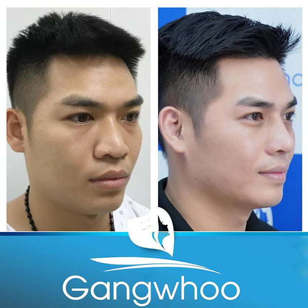 Thẩm mỹ viện Gangwhoo nâng mũi L–Line hóa “soái ca” - 6