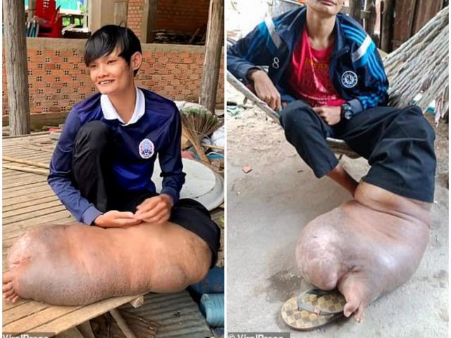 Phi thường - kỳ quặc - Chỉ một vết muỗi đốt, chân người đàn ông sưng to bằng một con lợn