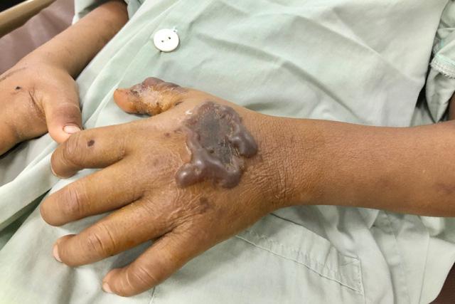 Vết cắn của rắn lục đuôi đỏ trên tay bệnh nhi Đinh Lý Duy