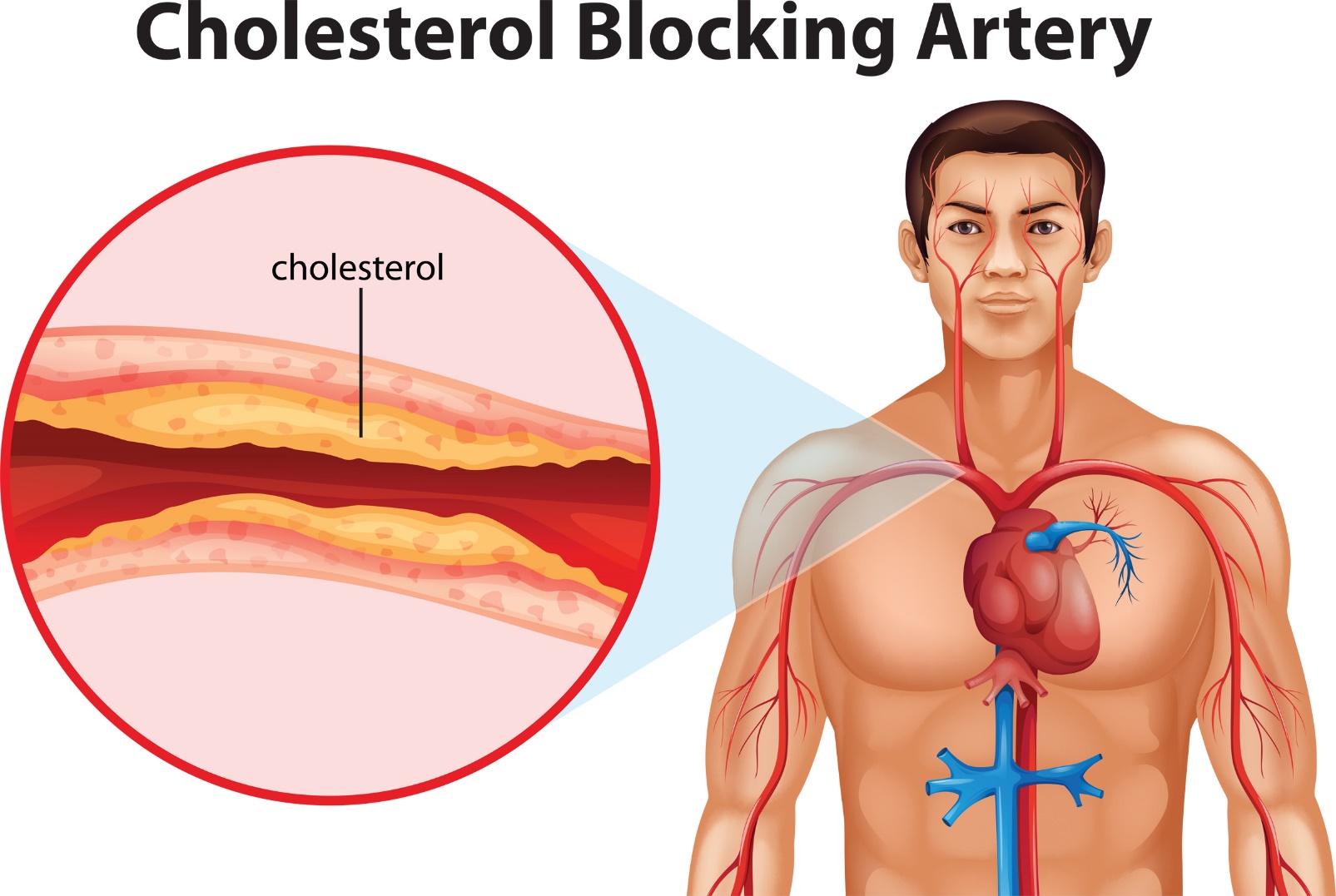 Cholesterol cao ảnh hưởng dễ biến chứng nguy hiểm
