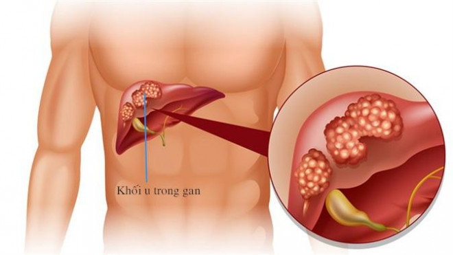 20 tuổi đột ngột phát hiện ung thư gan chỉ qua biểu hiện nhỏ - 1