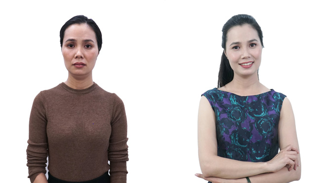 &nbsp;Chị Hải Anh (37 tuổi, Hà Nội) đã trải nghiệm dịch vụ căng chỉ Be Young tại JK Beauty Center