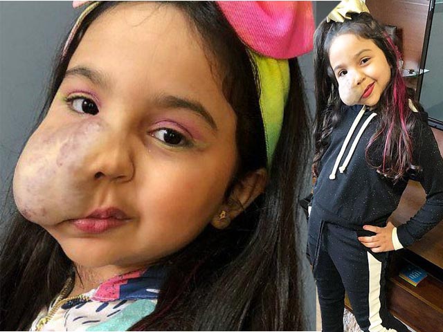 Bạn trẻ - Cuộc sống - Sinh ra với khối u mặt lớn đến nỗi không dám soi gương, bé gái trở thành ngôi sao MXH