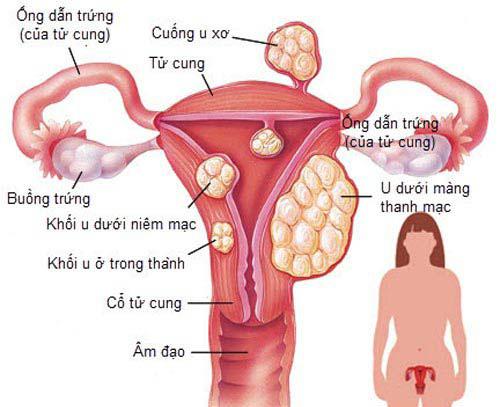 Hoảng hồn với những phụ nữ đau bụng quằn quại vào viện mới biết mang khối u khủng - 4