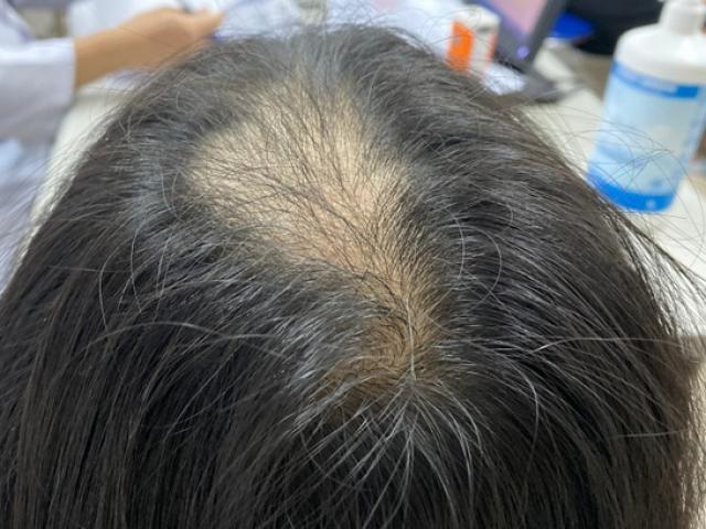 Bé 11 tuổi ở Hà Nội mắc chứng cứ ngồi học là nghiện nhổ tóc