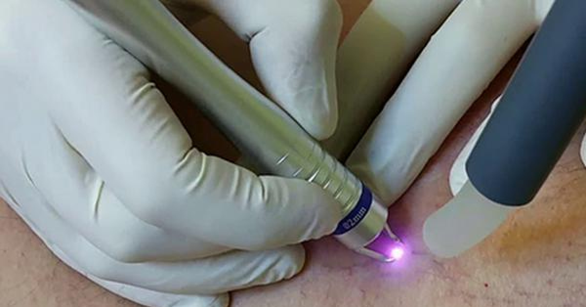 Làm đẹp - Giãn mao mạch ảnh hưởng thẩm mỹ của da