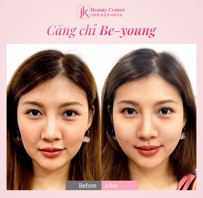 Căng chỉ chuẩn y khoa Be Young được phái đẹp Việt yêu thích - 2