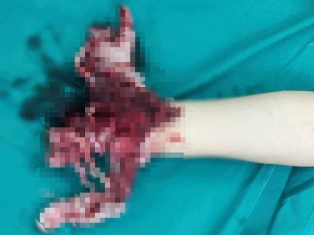 Sức khỏe đời sống - Nổ bình ga mini khi đang nấu ăn, người đàn ông mất đi bàn tay phải